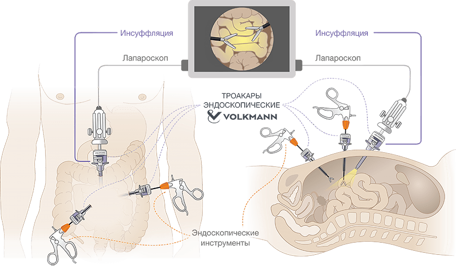 Схема использования эндоскопических троакаров при лапароскопии